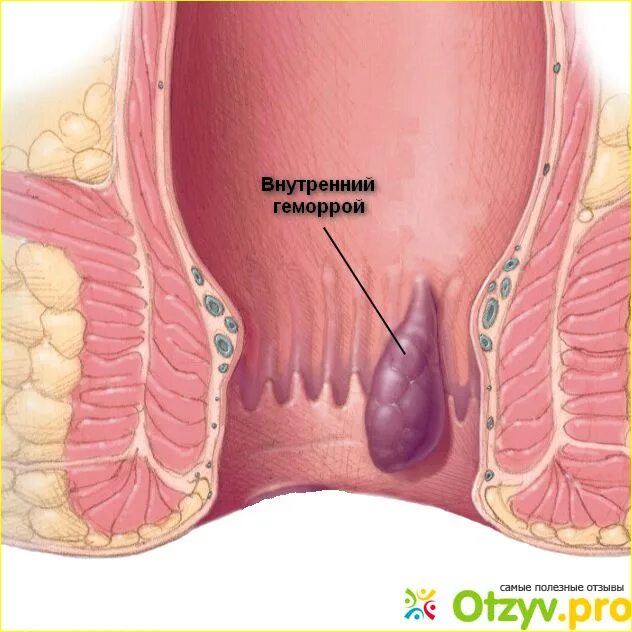 Первая стадия геморроя фото ПРОКТОГЛИВЕНОЛ мазь инструкция цена отзывы советы и инструкции 11:19 2024