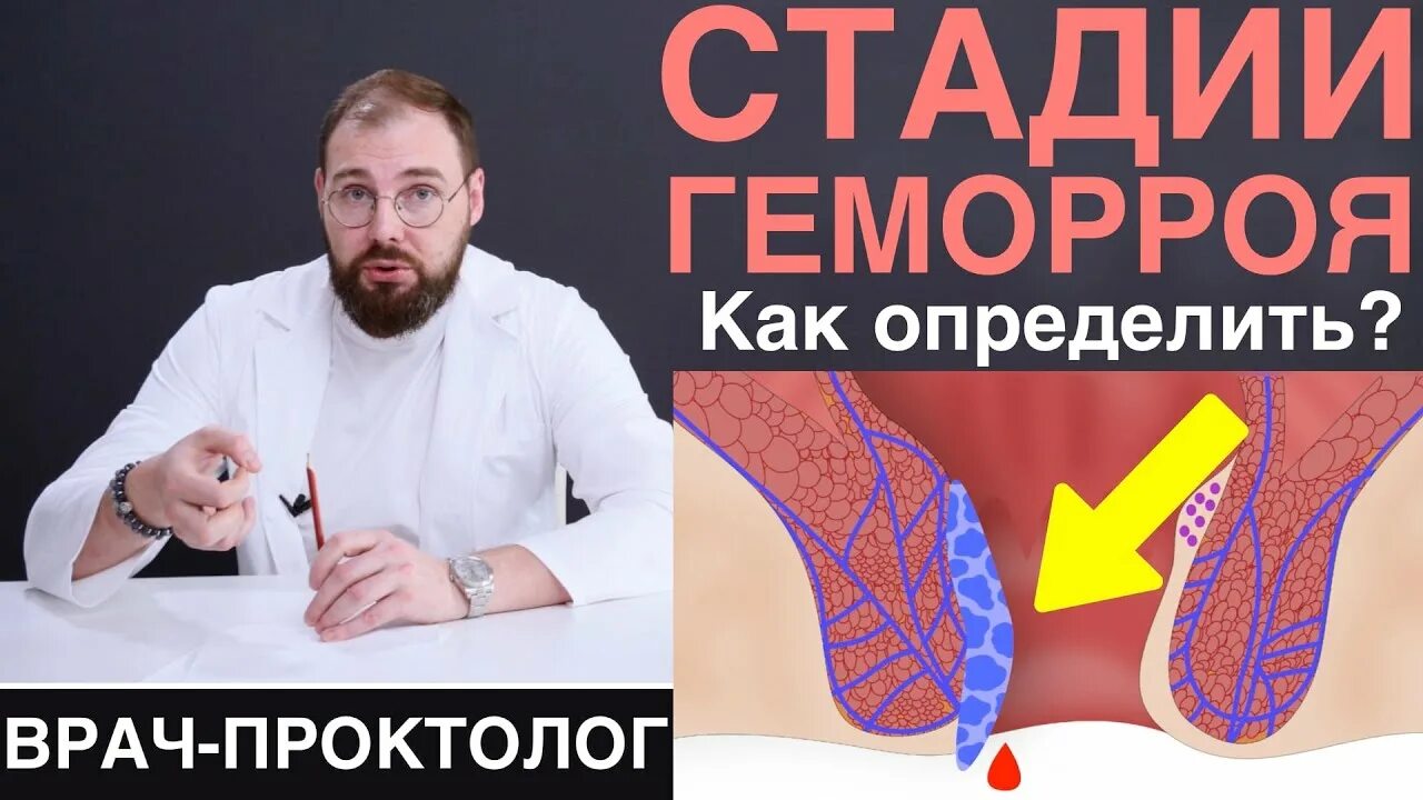 Первая стадия геморроя фото Геморрой - как правильно определить стадию геморроя, последствия неправильного д