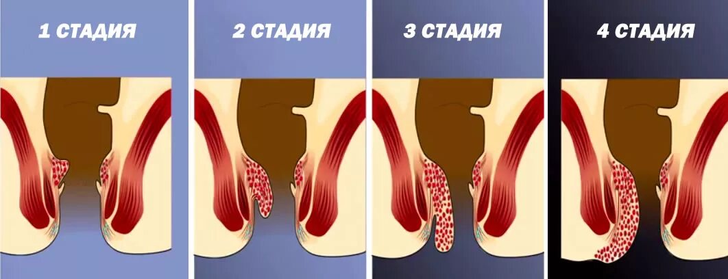 Первая стадия геморроя фото у мужчин Лечение геморроя в Ангарске - лазерная хирургия