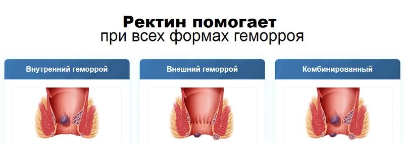 Первая стадия геморроя фото у мужчин ⌛"РЕКТИН" СВЕЧИ ОТ ГЕМОРРОЯ - ИНСТРУКЦИЯ ПО ПРИМЕНЕНИЮ, ЦЕНА, ОТЗЫВЫ, АНАЛОГИ * 
