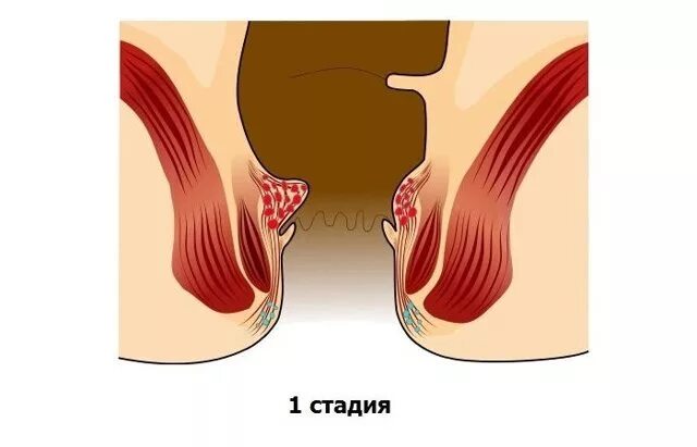 Первая стадия геморроя фото у мужчин Початкова стадія геморою: як виглядає, причини, симптоми і лікування - Світ Здор