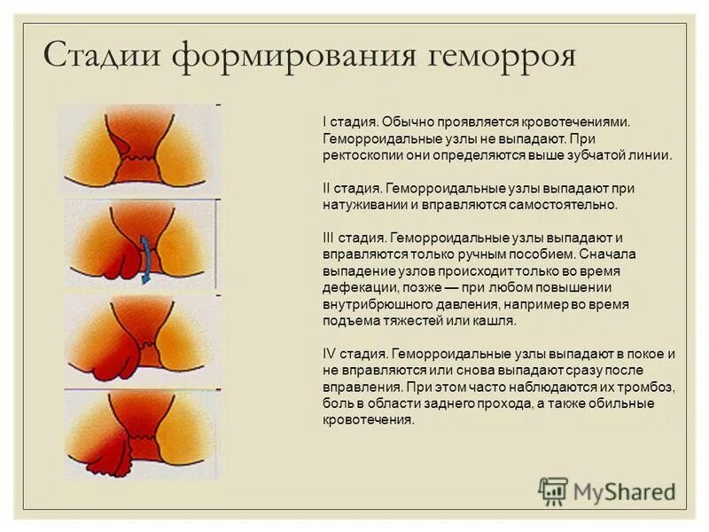 Первая стадия геморроя фото у мужчин Стадии наружного геморроя схема