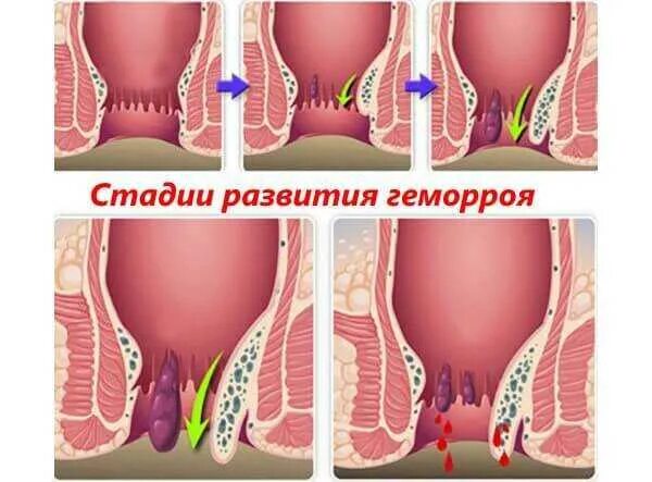 Первая стадия геморроя фото у женщин Стадии геморроя схема