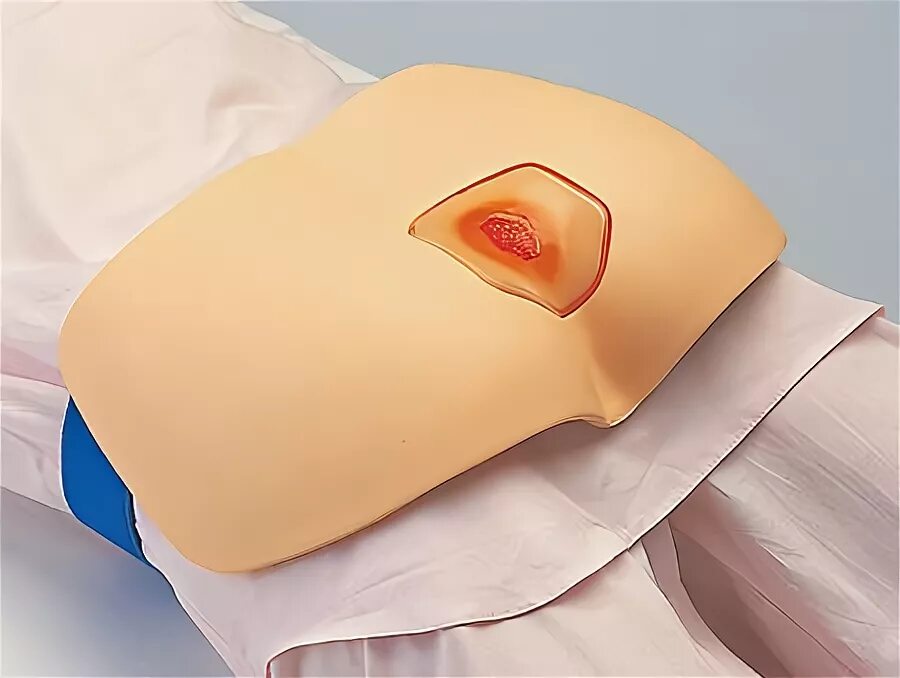 Первая стадия пролежней фото Health Management and Leadership Portal Sciatic nerve anatomical model / acupunc