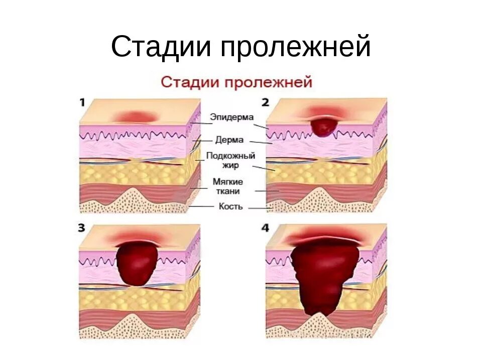 Первая стадия пролежней фото В статье описаны методы лечения пролежней у лежачих больных, средства профилакти