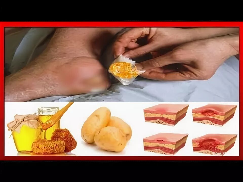 Первая стадия пролежней фото ПРОЛЕЖНИ лечим народными методами / мед и картофель для лечения пролежней - YouT