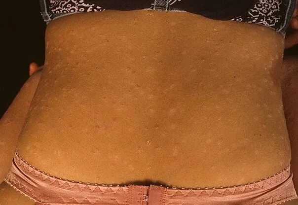 Первая стадия псориаза фото How to quickly cure psoriasis at home? 2022 Еда по-настоящему Meal4real VK