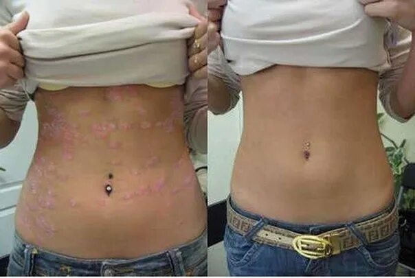 Первая стадия псориаза фото Realistically ! Result in 1 mes. The hormones weren't used at all. I'm delighted