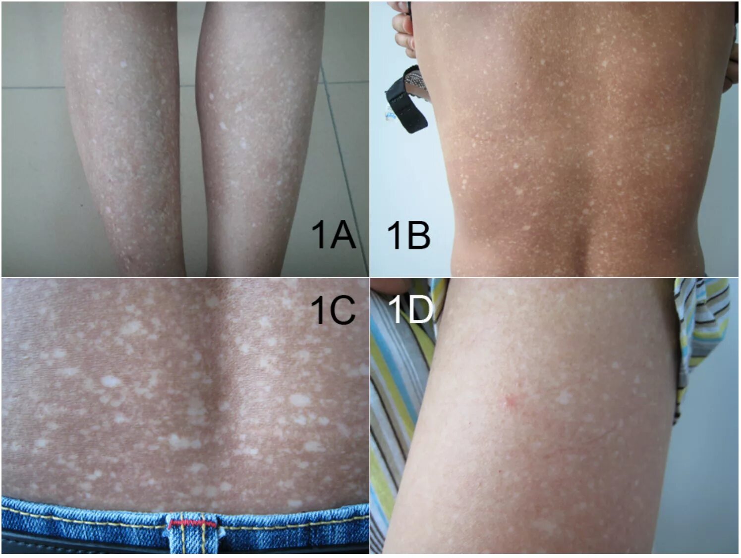 Первая стадия псориаза фото File:Amyloidosis cutis dyschromica.png - Wikipedia