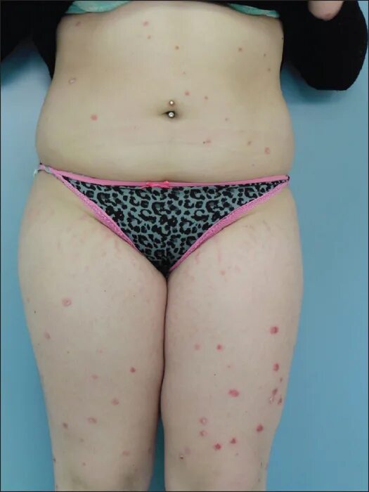 Первая стадия псориаза фото JLE - European Journal of Dermatology - Childhood psoriasis