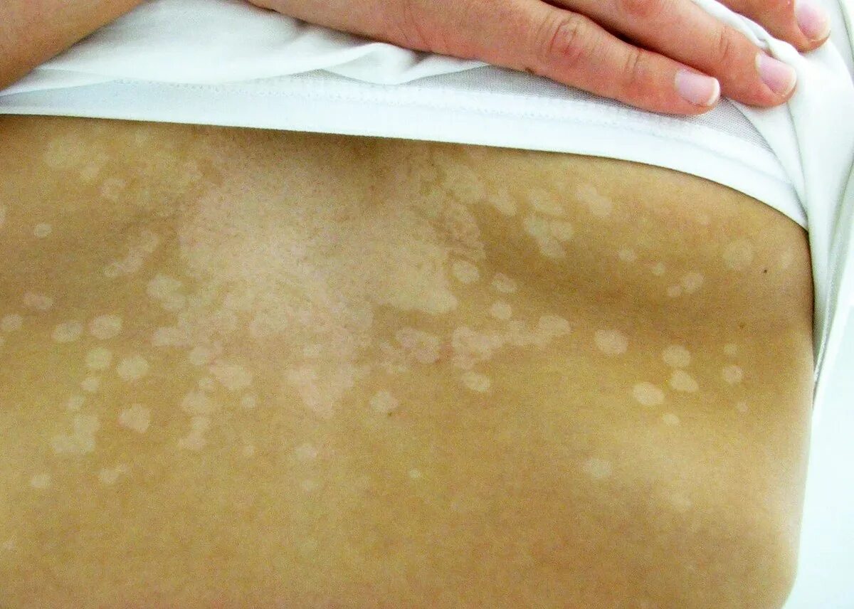Первая стадия псориаза фото Tinea versicolor - Wikipedia