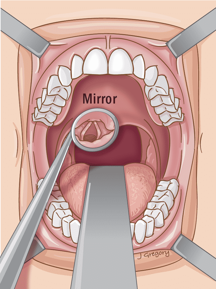 Первая стадия рака горла фото What is Endoscopy * Cancer Basics * THANC Guide