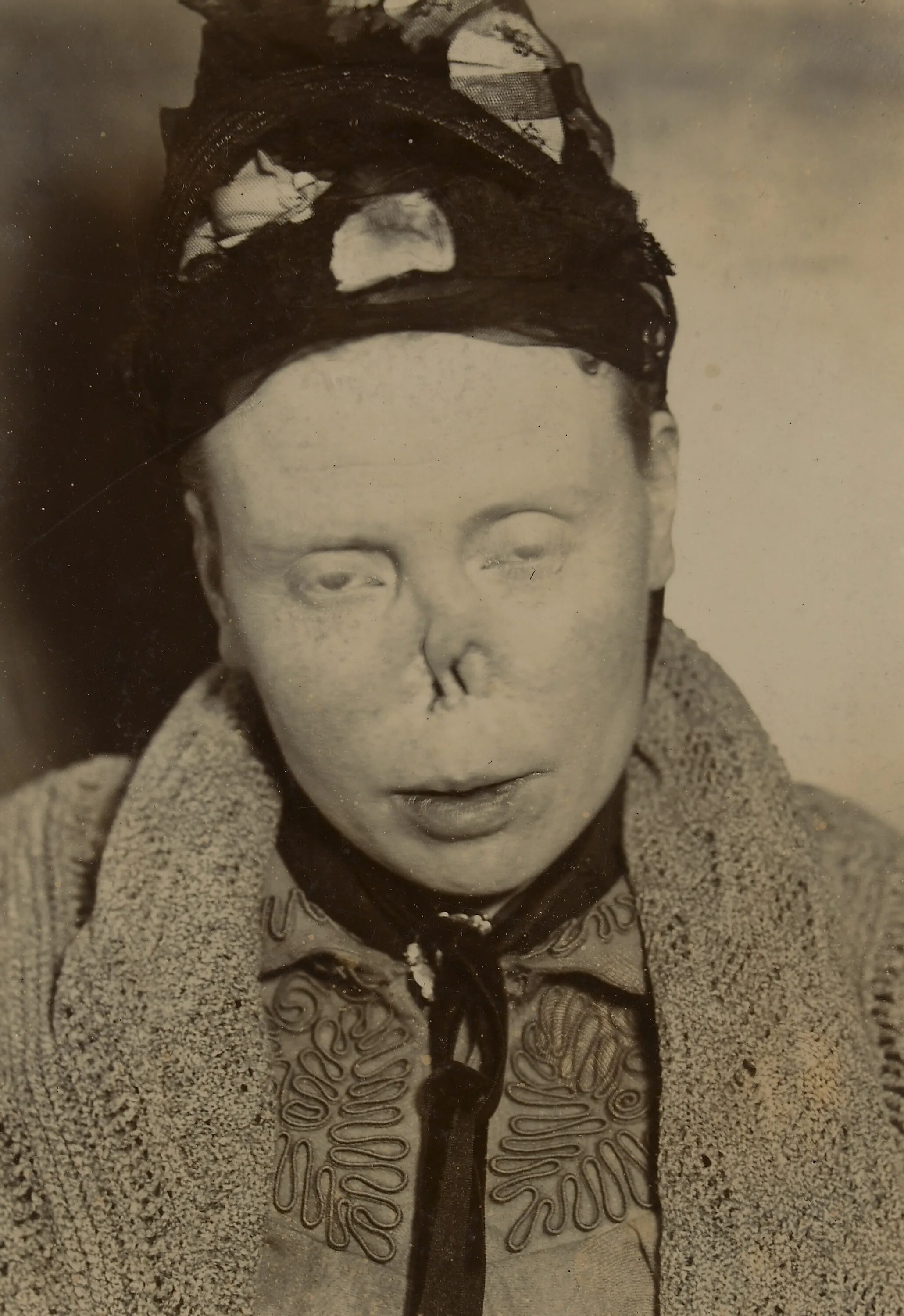 Первая стадия сифилиса фото File:Face of a woman with a typical 'syphilitic nose' Wellcome L0062955.jpg - Wi