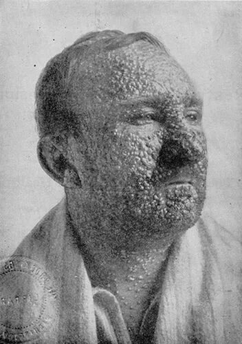 Первая стадия сифилиса фото Файл:SmallpoxvictimIllinois1912.jpg - Википедия