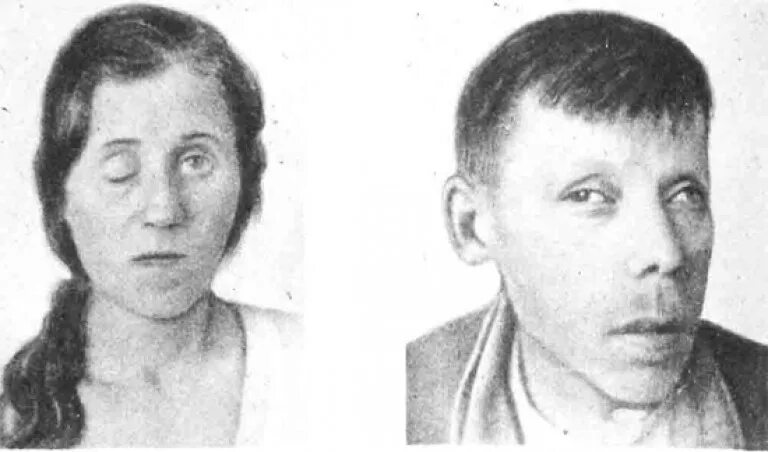 Первая стадия сифилиса фото Neurosyphilis: symptoms, diagnosis, treatment. Tabes dorsalis. Photo