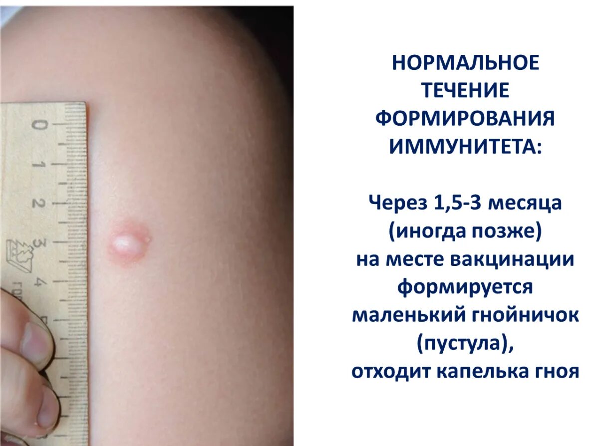Первая стадия ветрянки у детей фото Манту проверяют на какой
