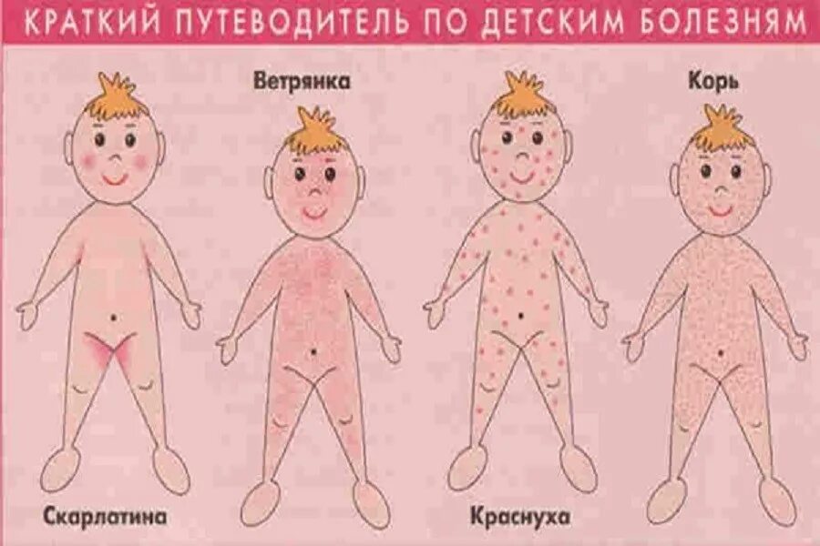 Первая стадия ветрянки у детей фото Краснуха у детей: причины и симптомы - статьи и последние новости по теме Разное