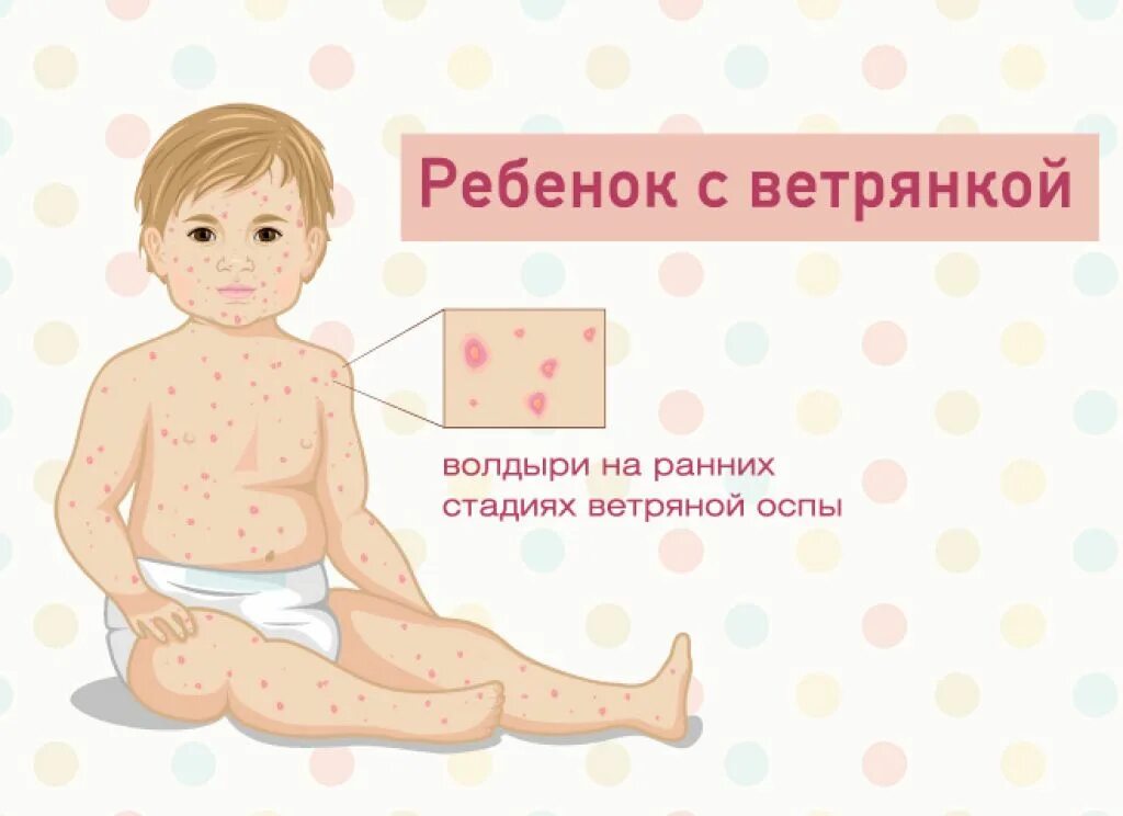 Первая стадия ветрянки у детей фото Ветрянка у детей: первые признаки и 6 главных симптомов, лечение, осложнения, пр