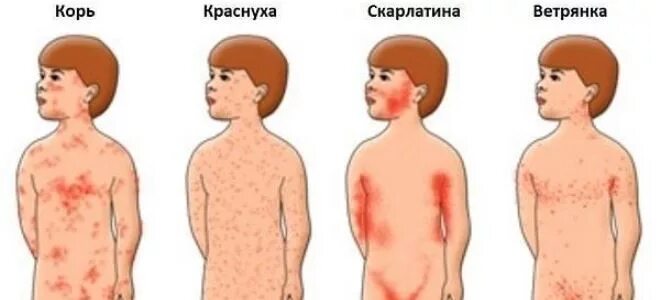 Первая стадия ветрянки у детей фото Краснуха у детей: симптомы, лечение, профилактика, видео