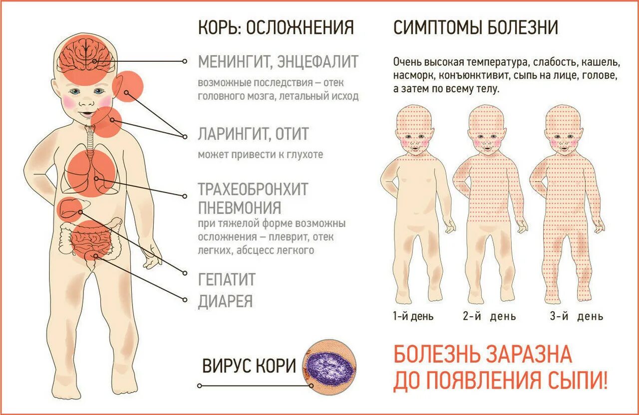 Первые симптомы кори у взрослого фото Три случая заболевания корью выявили в этом году в Красноярском крае Здоровье Се