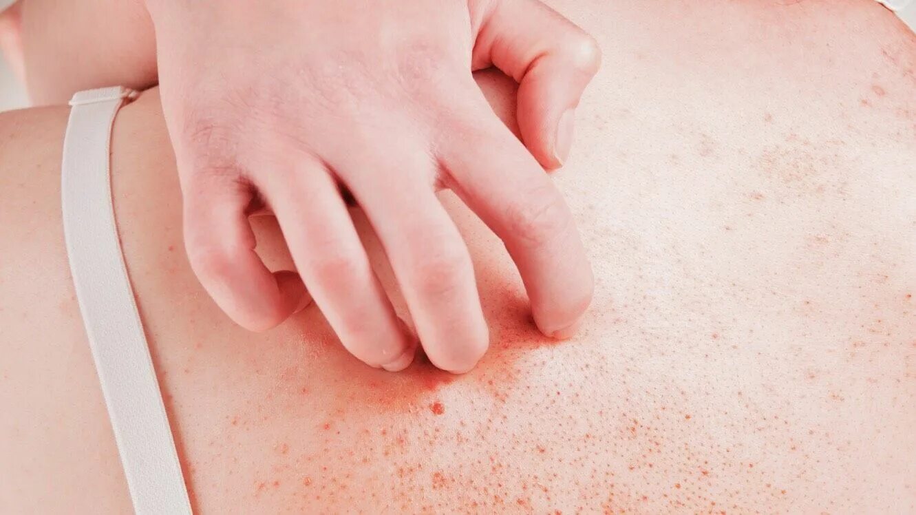 Пищевая аллергия фото сыпи на теле 20 Signs of An Autoimmune Disorder (And How To Reverse It)