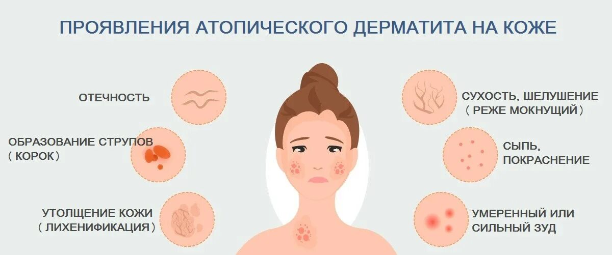 Пищевая аллергия как выглядит сыпь Атопический дерматит у взрослых (причины, способы лечения)