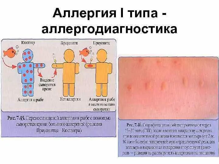 Пищевая аллергия как выглядит сыпь Как называется аллергическая реакция