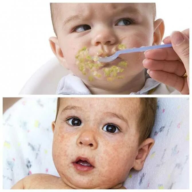 Пищевая аллергия на прикорм как выглядит Red cheeks baby food allergy