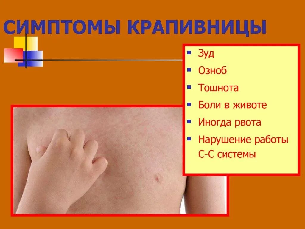 Пищевая аллергия сыпь фото Крапивница: серьезное заболевание или временное неудобство? - Ульфар