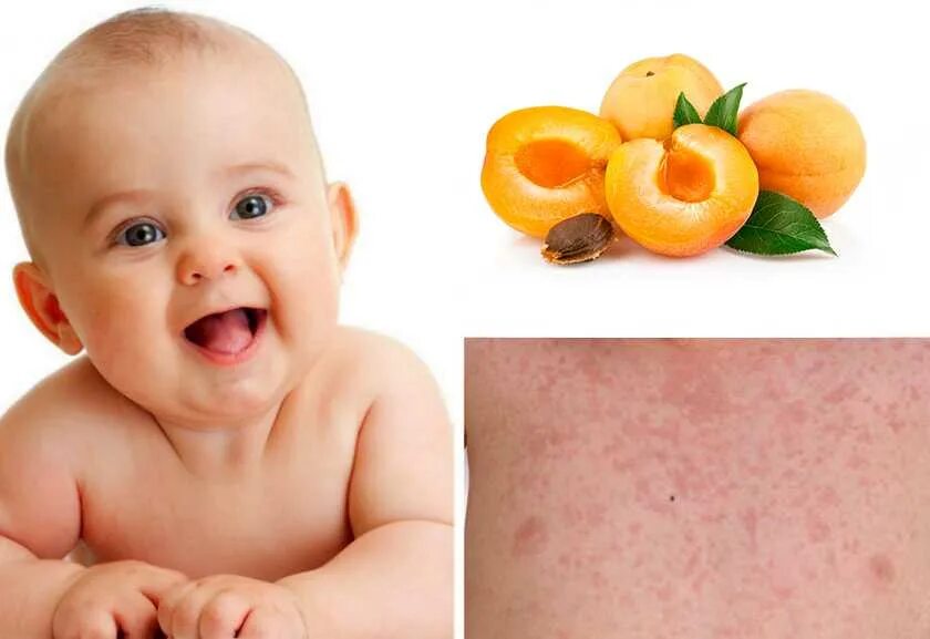 Пищевая аллергия сыпь фото Baby food allergy rash pics