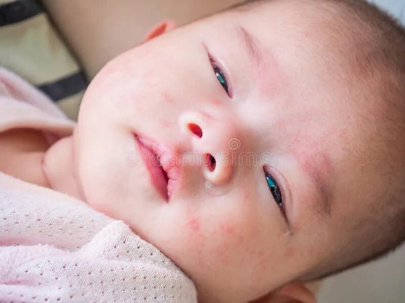 Пищевая аллергия у детей фото сыпи Newborn Baby with Allergy on Face Stock Image - Image of human, medical: 1727670