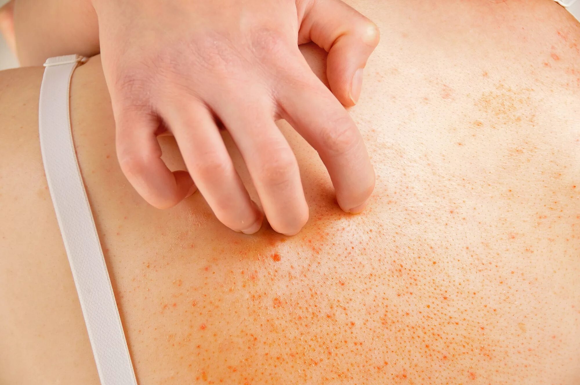 Пищевая сыпь фото Acne Risk and Severity in Patients With AD Varies By Age and Sex - Dermatology A