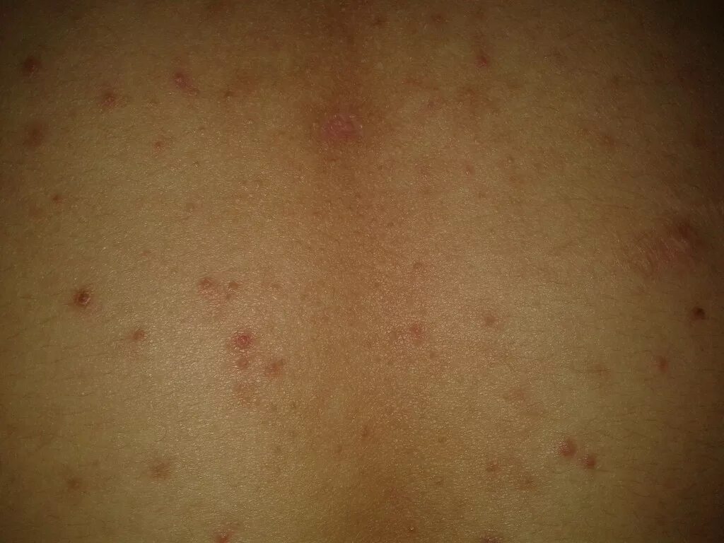 Пищевая сыпь фото Прыщики на спише, похоже на сыпь. - Вопрос дерматологу - 03 Онлайн
