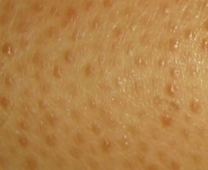 Пищевая сыпь фото Itchy bumps on cliterus