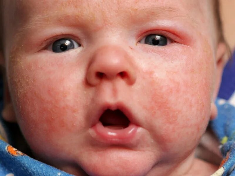 Пищевая сыпь у ребенка фото Atopic Dermatitis Symptoms in Children Are Persistent