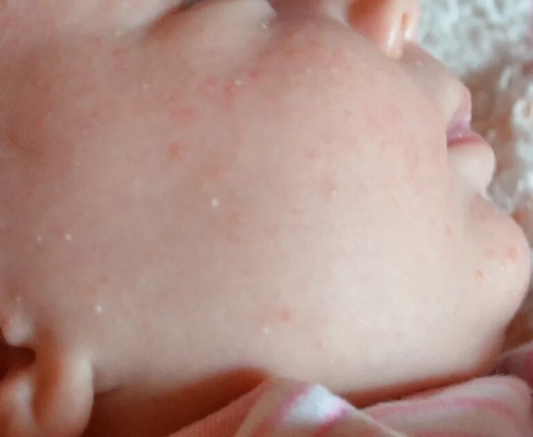 Пищевая сыпь у ребенка фото Les boutons blancs dans le nouveau-né et le bébé.Comment traiter les boutons bla