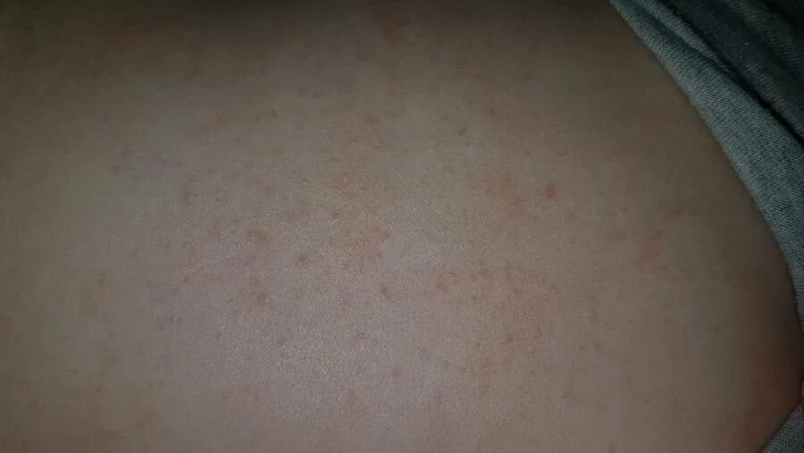Пищевая сыпь у взрослого фото Сыпь у грудничка на спине, теле, коже: причины