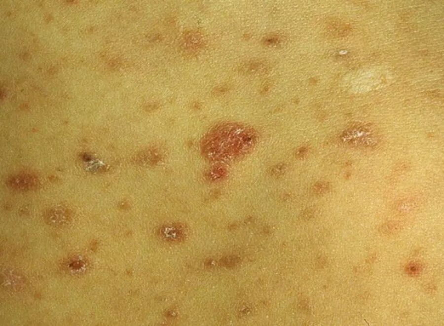 Пищевая сыпь у взрослого фото Освежился, получи церкариоз. : aborigenarbata - ЖЖ