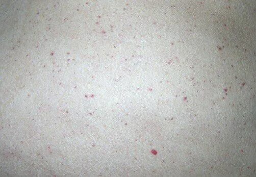 Пищевая сыпь у взрослого фото Жизнь взаперти и гиперграфия как главная улика Fishki.Net Дзен