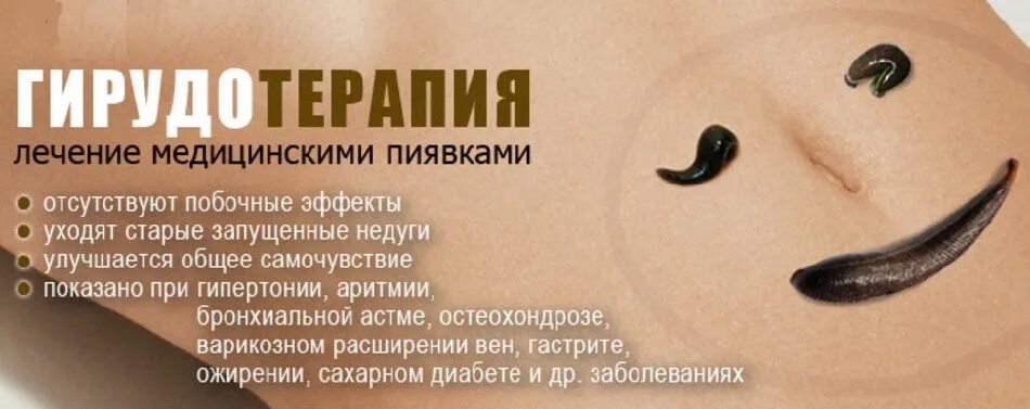 Пиявка медицинская фото крупно Угланов В.Ю. Гирудотерапия - лечение пиявками. Личный опыт.