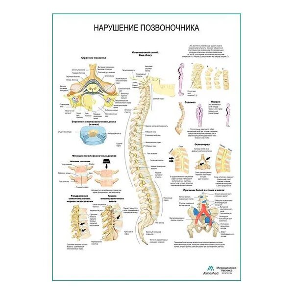 Плакат позвоночник и болезни медицинский фото Нарушения позвоночника (анатомия человека) плакат глянцевый А1+, плотная фотобум