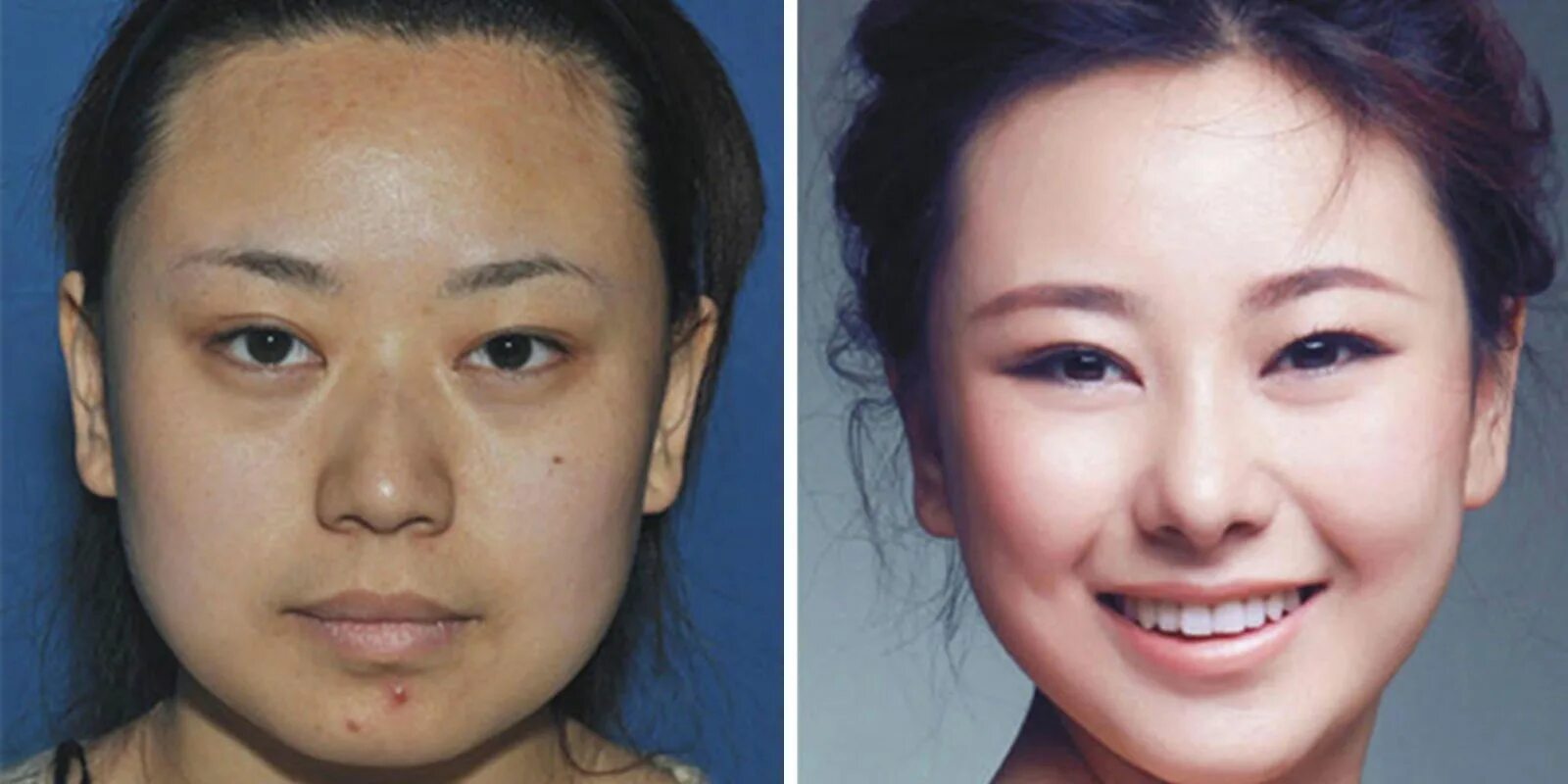 Пластика глаз до и после фото These Women Have Had So Much Plastic Surgery They Can't Get Through Airport Secu