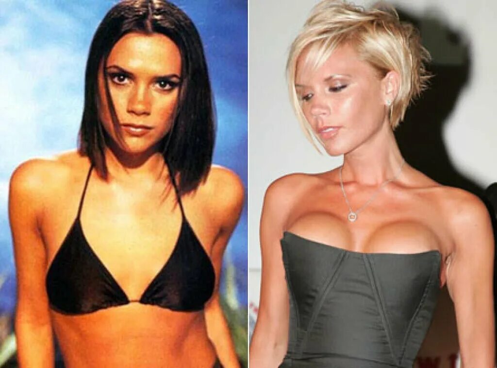 Пластика груди фото до и после FOTO Victoria Beckham (46) poslala dráždivý pozdrav fanúšikom: TOTO telo má v po
