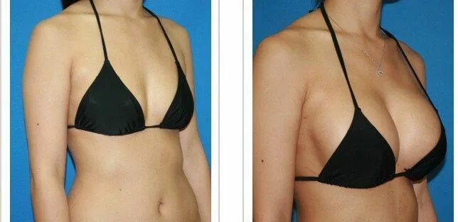 Пластика груди фото до и после breast-augmentation-before-after Augmentation Silicone implants, Breast