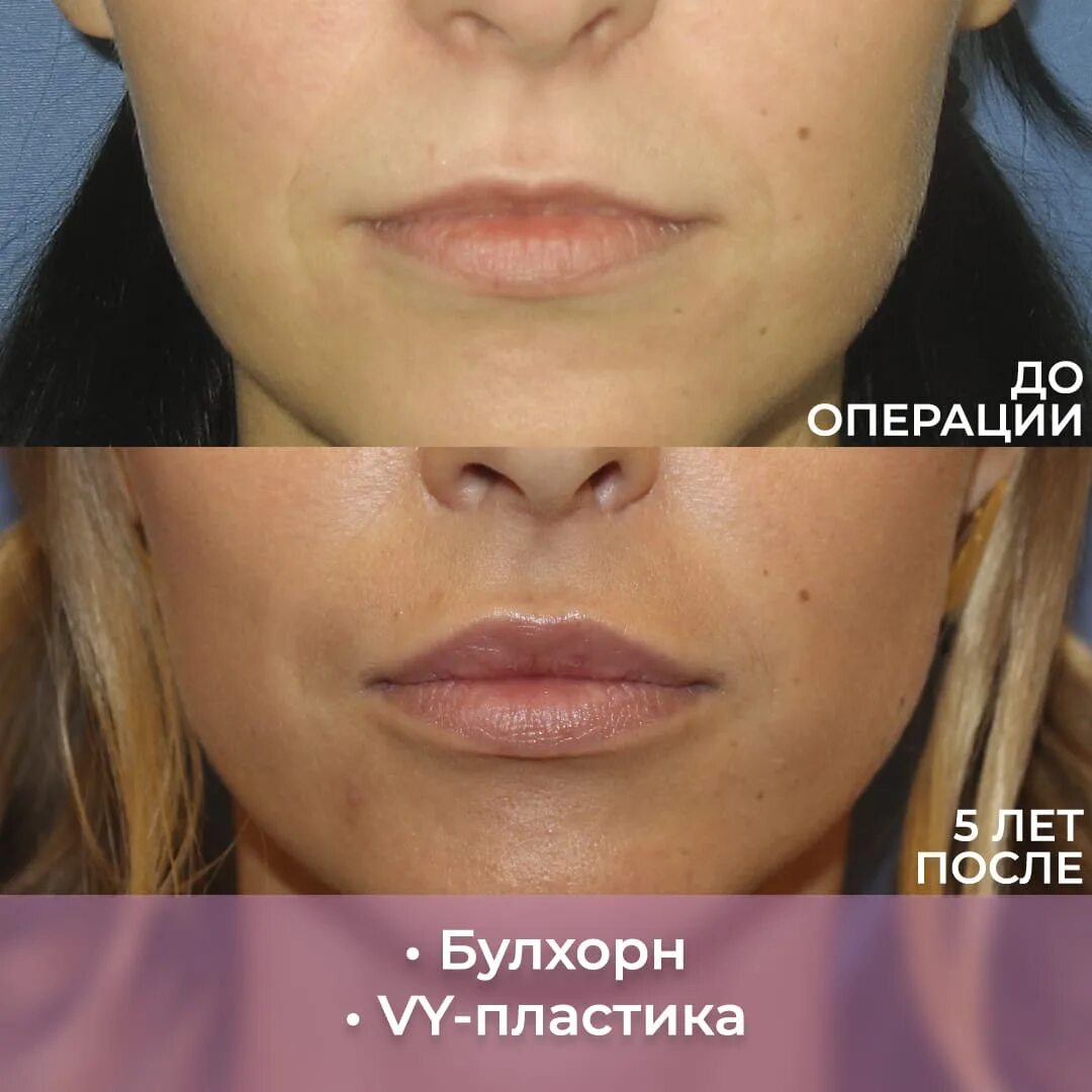 Пластика губ булхорн до и после фото Клиника пластической хирургии "Абриелль"