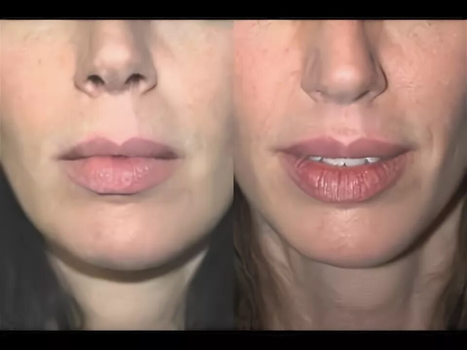 Пластика губ булхорн до и после фото Lip Lift Surgery Before and After by Top NYC Plastic Surgeon Dr Andrew Jacono #l