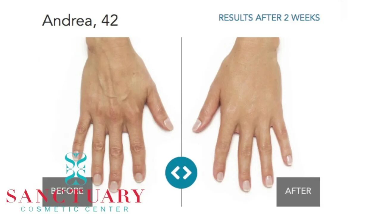 Пластика кистей рук фото до и после Anti-aging Treatments for Your Hands-Stop the aging - YouTube