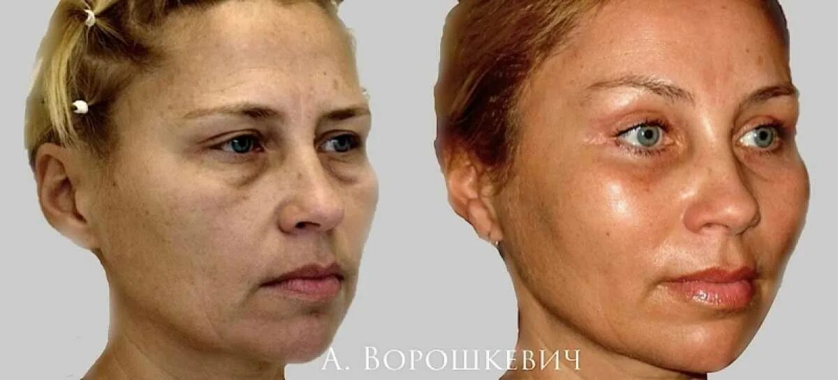 Пластика лба до и после фото Операция по поднятию: найдено 86 изображений