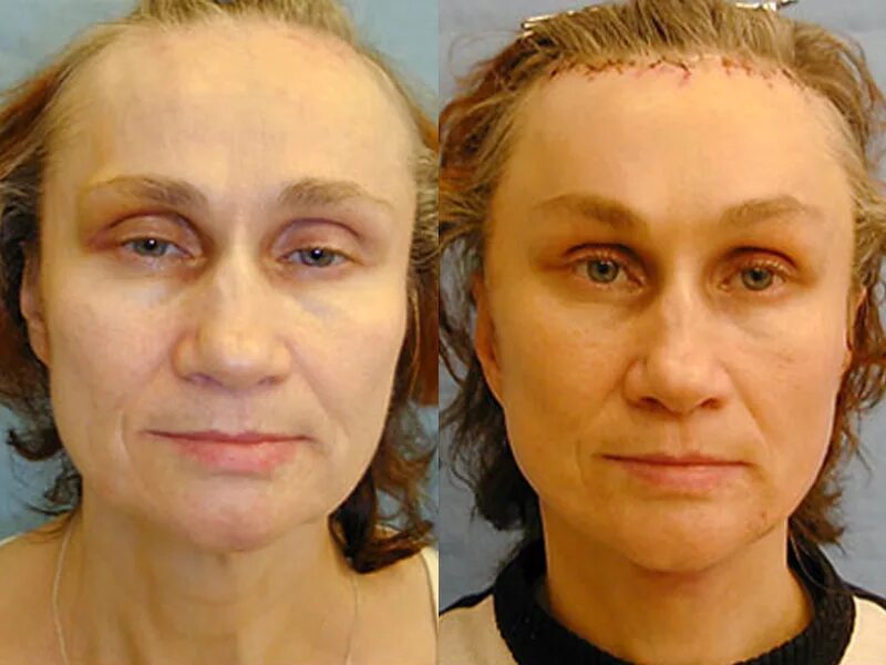 Пластика лба до и после фото Уход после пластики