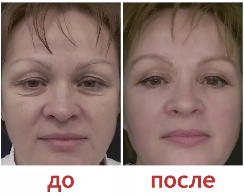 Пластика нижних век фото до и после Верхние веки после блефаропластики